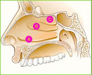 Операции (вазотомия и конхопластика) на носовых раковинах