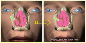 Гипертрофия нижних носовых раковин